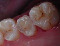 Tooth Colored Filling During Treatment