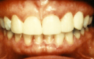 Closeup of Bonded Canines to Mimic Missing Lateral Incisors