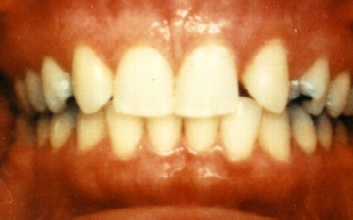 Before Picture of Missing Lateral Incisors