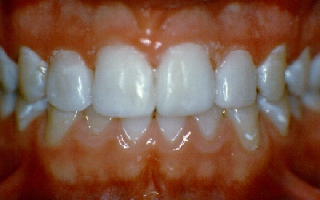 After Picture of Small Teeth With Gaps Closed by Bonding
