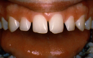 Before Picture of Small Teeth With Gaps