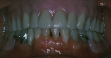Front view of new upper denture and new lower parital denture