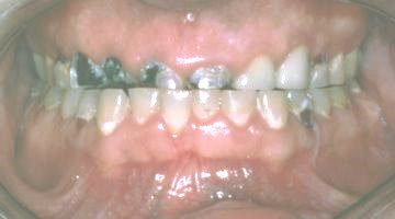 Extreme tooth decay and teeth grinding
