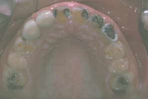 Upper view of extreme tooth decay and teeth grinding