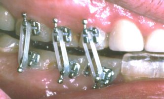 Orthodontics used to increase the space needed to create a beautiful smile