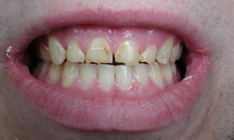 Teeth erosion damage