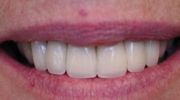 Teeth erosion repaired with porcelain crowns