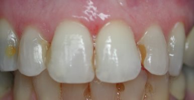 Picture of discolored fillings in front teeth.