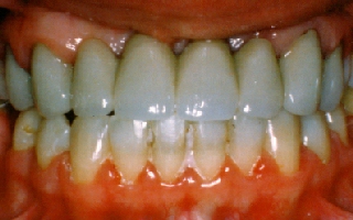 Closeup view of a new bridge to replace four missing front teeth