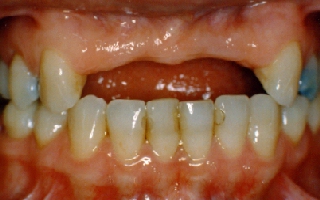 Missing teeth previously replaced by a partial denture