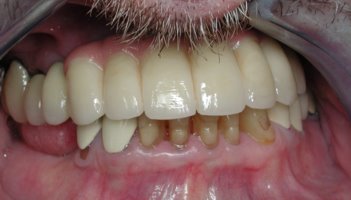 Closeup of dental implants with a fixed bridge securely affixed