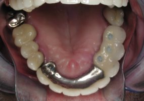 View of dental implants with a new fixed bridge securely affixed
