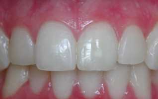 Discolored tooth after internal tooth bleaching