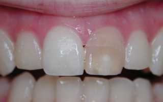 Discolored tooth before internal tooth bleaching