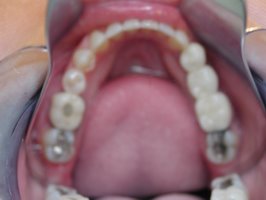 Close gaps with invisible braces after lower view