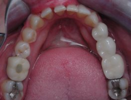 Close gaps with invisible braces before lower view