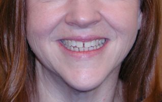 Smile before gap is closed with invisible braces