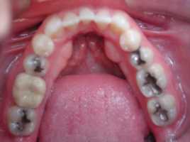 Invisalign Lilburn after clear braces