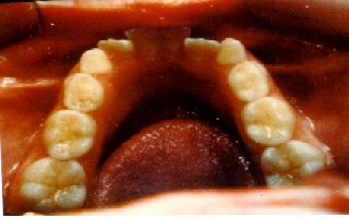 Crowded teeth before being straightened with retainers only