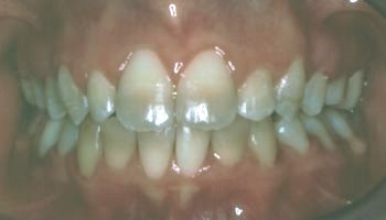 Crowded teeth straightened with braces front view