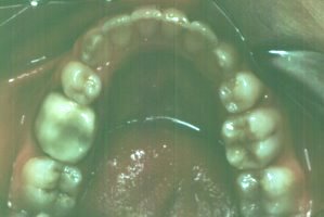 Crowded teeth straightened with braces lower chewing surface view