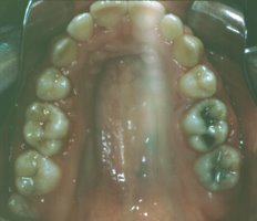 Crowded teeth straightened with braces upper chewing surface view