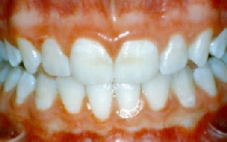 Crooked teeth after being straightened with retainers only