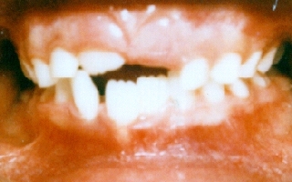 Front view of crooked teeth before being straightened with retainers only