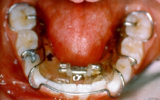 Teeth retainer used to straighten teeth