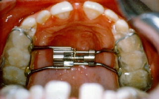 Teeth retainer used to straighten teeth