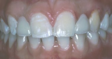 A Maryland bridge is used to replace congenitally missing lateral incisors