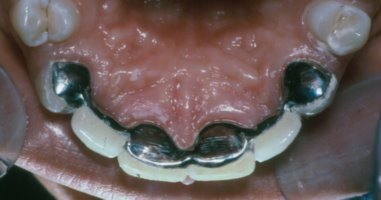 A Maryland bridge is used to replace congenitally missing lateral incisors