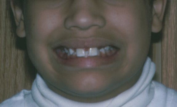 Before picture of a patient with congenitally missing lateral incisor teeth