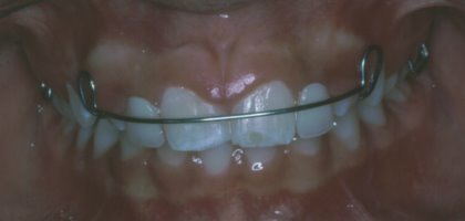 A retainer is used to guide the canine teeth into the proper position