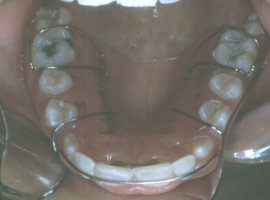 A retainer is used to guide the canine teeth into the proper position