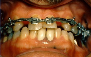 Braces were used in this 55 year old patient to move the front teeth into proper position