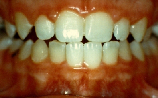 Overbite was corrected with only a simple retainer
