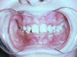 This patient has a bad overbite and overjet