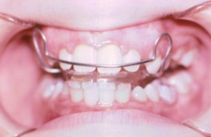 Use of a retainer for overbite correction