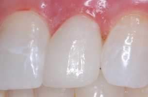 Peg lateral incisor after being restored with a porcelain laminate