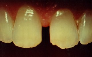 Gap in front teeth