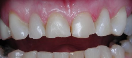 Chipped teeth before being restored with porcelain laminates