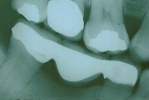 X-ray of teeth after placement of a bridge