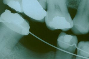 X-ray of teeth during orthodontic uprighting