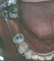 Teeth during orthodontic uprighting
