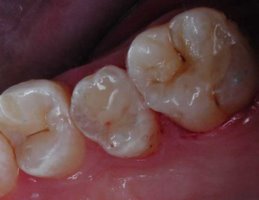 A cavity filled with a tooth-colored filling (composite filling)