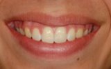 Overbite correction with a retainer