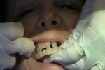 Atlanta Cosmetic Dentist Snap-On-Smile Video