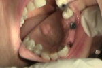 Implant Restoration Video