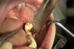 Wisdom Teeth Extraction Video